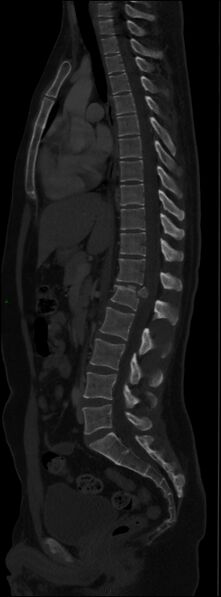 File:Burst fracture (Radiopaedia 83168-97542 Sagittal bone window 67).jpg
