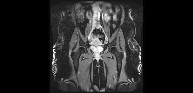 File:Buttock filler complications (Radiopaedia 63497-72115 Coronal T1 C+ 15).jpg