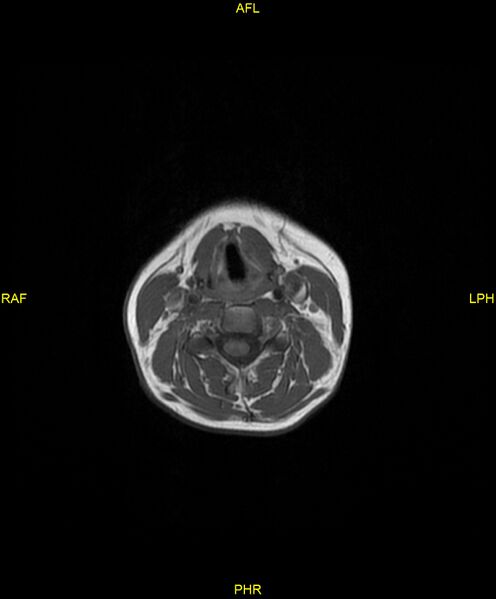 File:C5 nerve sheath tumor (Radiopaedia 85777-101596 Axial T1 13).jpg