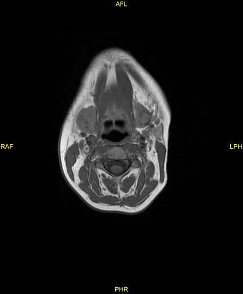 File:C5 nerve sheath tumor (Radiopaedia 85777-101596 Axial T1 9).jpg