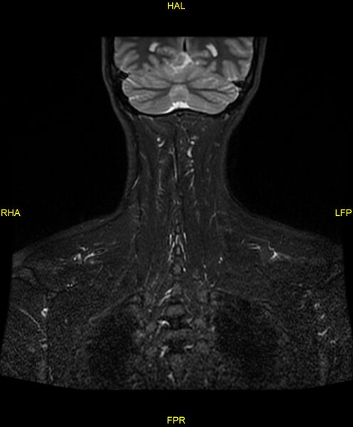 File:C5 nerve sheath tumor (Radiopaedia 85777-101596 Coronal T2 fat sat 19).jpg