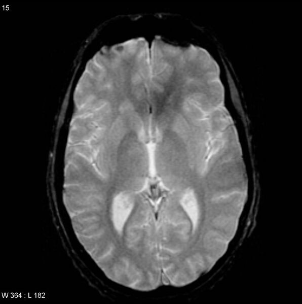 File:CMV ventriculitis and encephalitis (Radiopaedia 5416-7166 Axial Gradient Echo 3).jpg