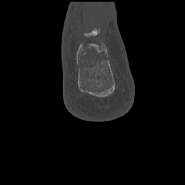 File:Calcaneal tuberosity avulsion fracture (Radiopaedia 22649-22668 Coronal bone window 65).jpg