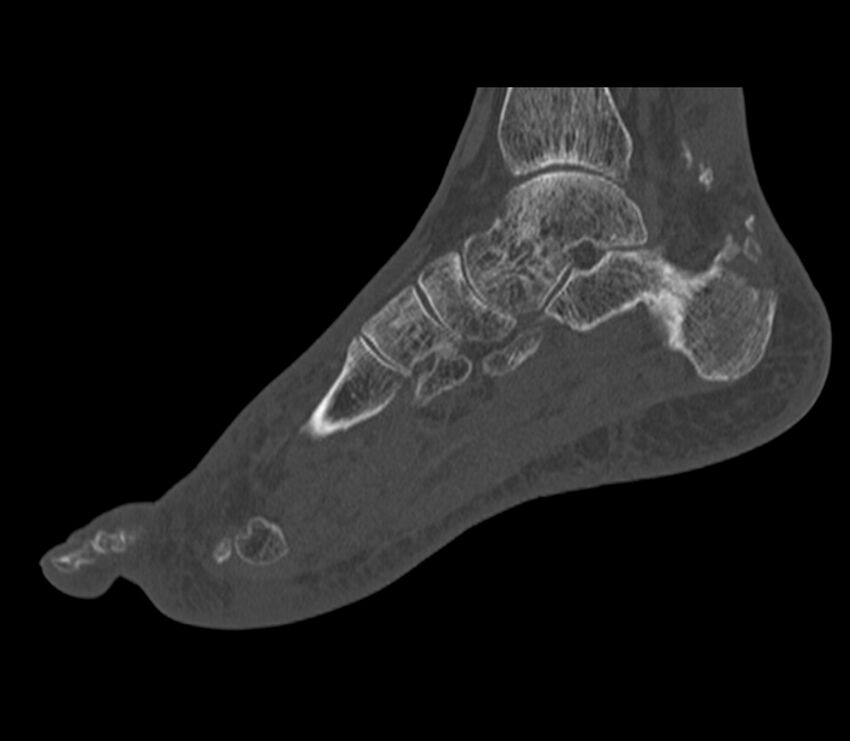 Calcaneal tuberosity avulsion fracture (Radiopaedia 22649-22668 Sagittal bone window 28).jpg