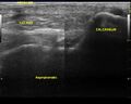 Calcaneal tuberosity avulsion fracture (Radiopaedia 42683).jpg