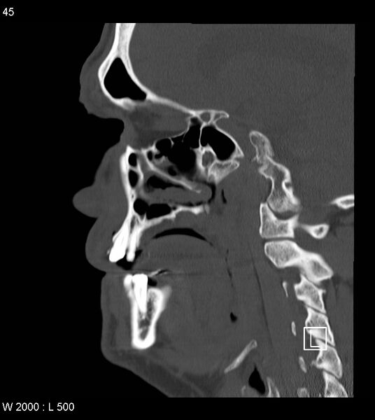 File:Calcification of the transverse band of the cruciform ligament (Radiopaedia 53063-59025 Sagittal bone window 22).jpg