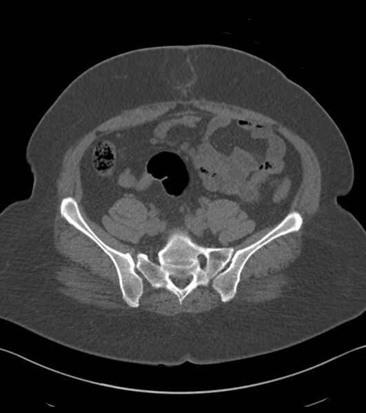 File:Calcified hepatic hydatid cyst (Radiopaedia 81127-94738 Axial non-contrast 74).jpg