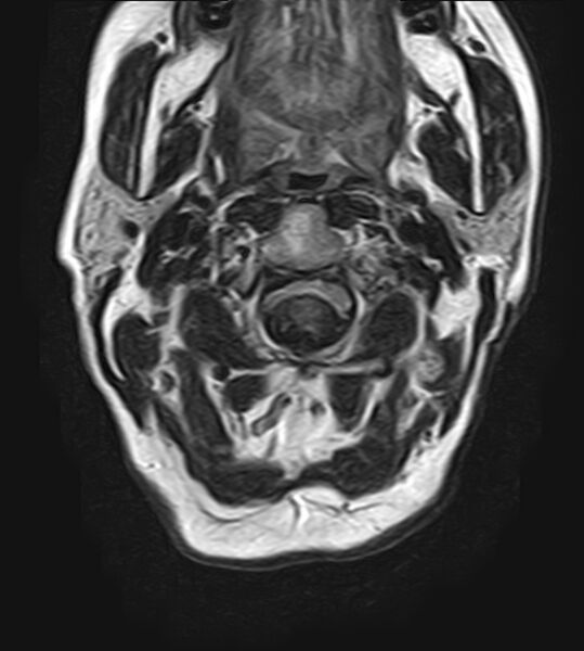 File:Calcified meningioma - cervical canal (Radiopaedia 70136-82468 Axial T2 8).jpg