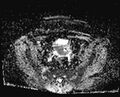 Cancer cervix - stage IIb (Radiopaedia 75411-86615 Axial ADC 22).jpg