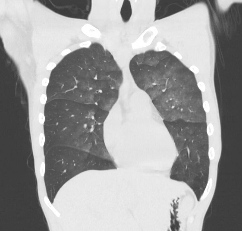 Cannabis-induced diffuse alveolar hemorrhage (Radiopaedia 89834-106946 Coronal lung window 63).jpg