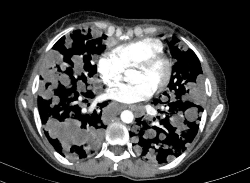 Cannonball metastases from breast cancer (Radiopaedia 91024-108569 A 74).jpg
