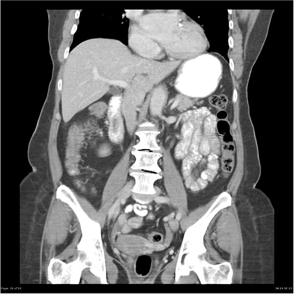 File:Carcinoid tumor of the ileum with metastasis to orbit (Radiopaedia 28165-28425 B 16).jpg