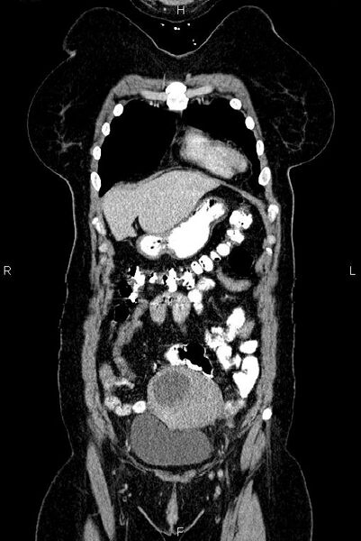 File:Carcinoma of uterine cervix (Radiopaedia 85861-101700 C 7).jpg
