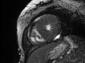 Cardiac amyloidosis (Radiopaedia 61600-69579 Short axis bSSFP 68).jpg