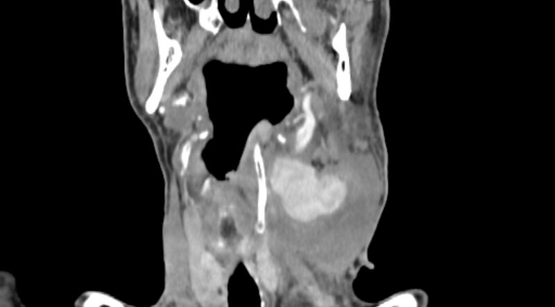 File:Carotid artery pseudoaneurysm (Radiopaedia 84030-99259 D 39).jpg