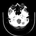 Carotid body tumor (Radiopaedia 27890-28124 A 2).jpg
