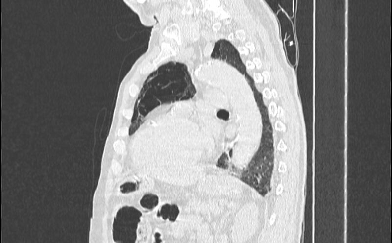 File:Cavitating bronchogenic carcinoma (Radiopaedia 44489-48162 Sagittal lung window 40).jpg