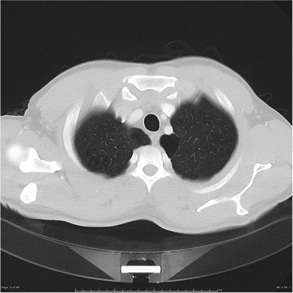 File:Cavitating lung cancer (Radiopaedia 25796-25945 Axial lung window 5).jpg