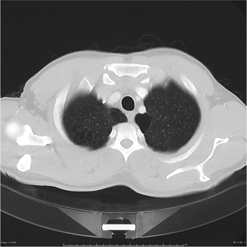 Cavitating lung cancer (Radiopaedia 25796-25945 Axial lung window 5).jpg