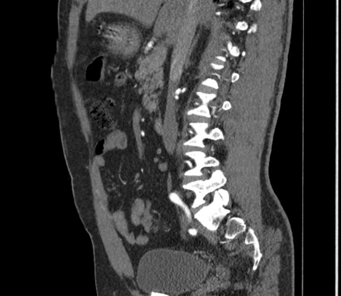 File:Celiac artery dissection (Radiopaedia 52194-58080 B 23).jpg