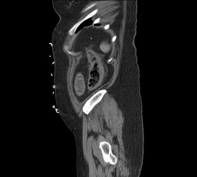 File:Celiac artery severe stenosis and dissection (Radiopaedia 44128-47842 A 5).jpg