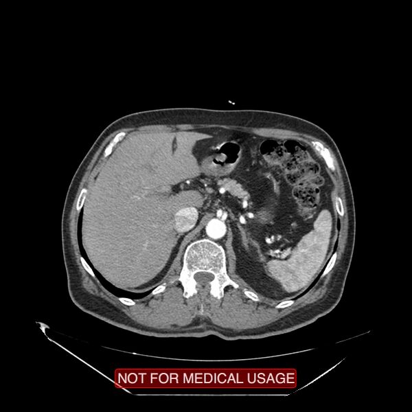 File:Celiac trunk variant anatomy - gastrohepatic trunk and splenic artery (Radiopaedia 38815-40995 A 14).jpg