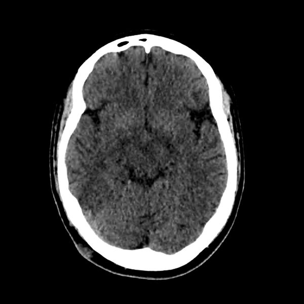 File:Central nervous system Langerhans cell histiocytosis (Radiopaedia 65728-74878 Axial non-contrast 23).jpg