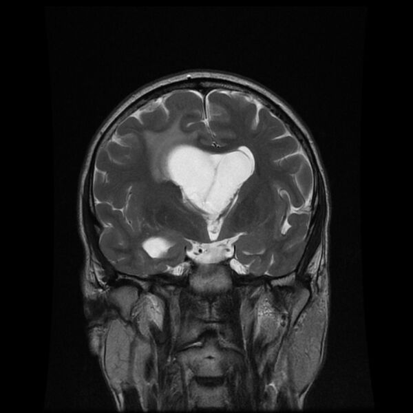 File:Central neurocytoma (Radiopaedia 67618-77021 Coronal T2 9).jpg
