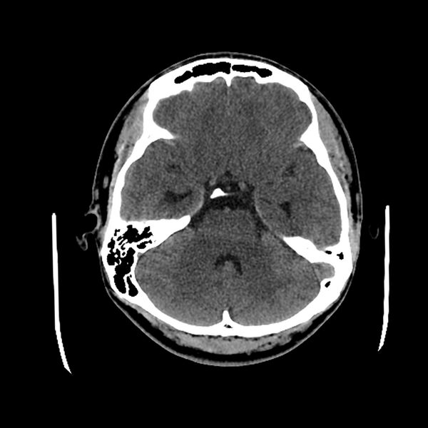 File:Central neurocytoma (Radiopaedia 79320-92379 Axial non-contrast 15).jpg