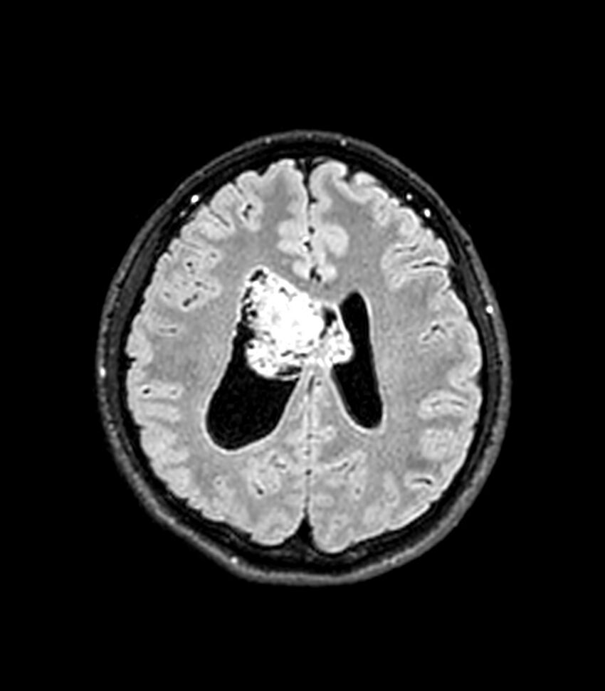 Central neurocytoma (Radiopaedia 79320-92380 Axial FLAIR 116).jpg