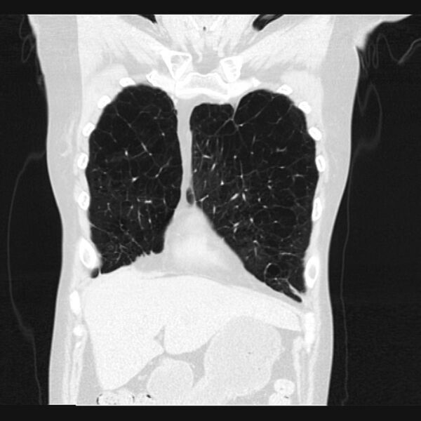 File:Centrilobular pulmonary emphysema (Radiopaedia 24495-24789 Coronal lung window 13).jpg