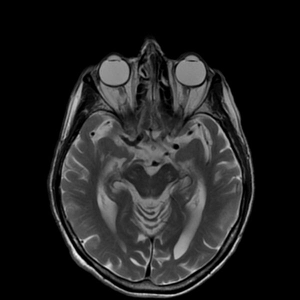 File:Cerebellar ataxia with neuropathy and vestibular areflexia syndrome (CANVAS) (Radiopaedia 74283-85159 Axial T2 10).jpg