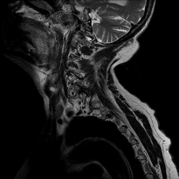 File:Cerebellar ataxia with neuropathy and vestibular areflexia syndrome (CANVAS) (Radiopaedia 74283-85159 Sagittal T2 12).jpg