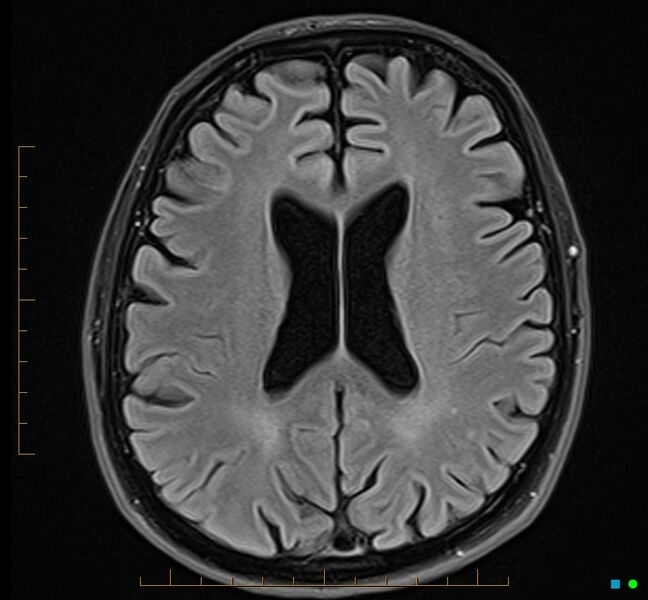 File:Cerebellar gangliocytoma (Radiopaedia 65377-74422 Axial FLAIR 24).jpg