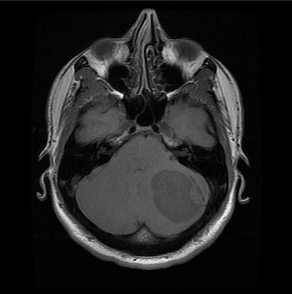 File:Cerebellar hemangioblastoma (Radiopaedia 11472-11835 Axial 2).jpg