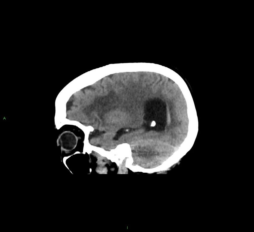 Cerebellar hemorrhage (Radiopaedia 58793-66027 C 17).jpg