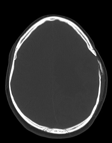 File:Cerebral abscesses (Radiopaedia 70458-80568 Axial bone window 42).jpg
