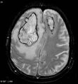 Cerebral abscesses secondary to contusions (Radiopaedia 5201-6968 Axial Gradient Echo 1).jpg