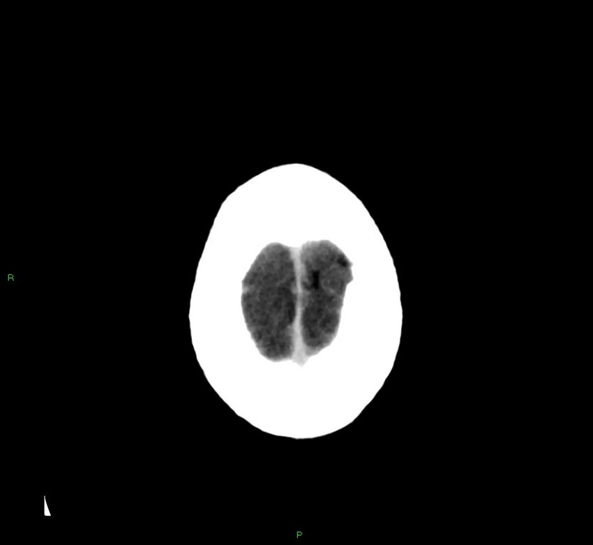 Cerebral amyloid angiopathy-associated lobar intracerebral hemorrhage (Radiopaedia 58376-65511 Axial non-contrast 7).jpg