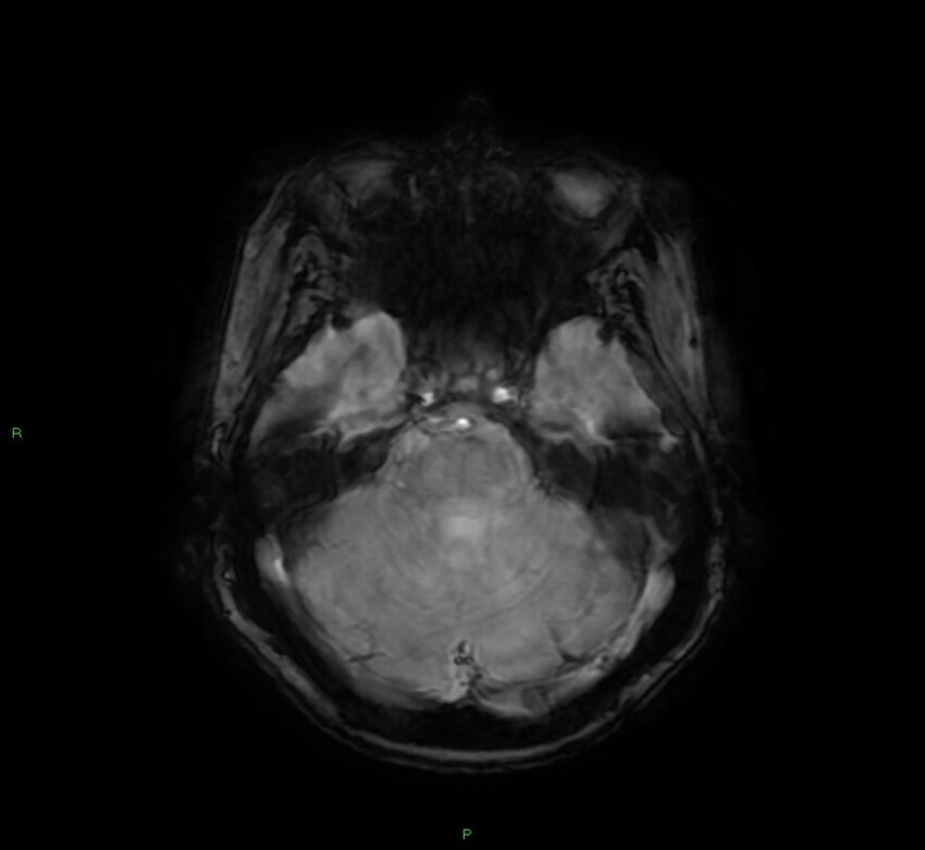 Cerebral amyloid angiopathy-associated lobar intracerebral hemorrhage (Radiopaedia 58378-65517 Axial SWI 21).jpg