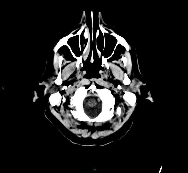 File:Cerebral amyloid angiopathy-associated lobar intracerebral hemorrhage (Radiopaedia 58529-65681 Axial non-contrast 49).jpg