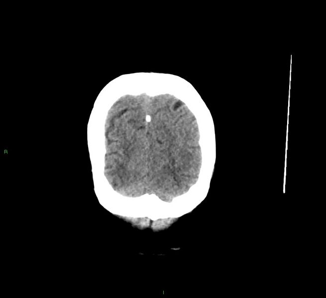 File:Cerebral amyloid angiopathy-associated lobar intracerebral hemorrhage (Radiopaedia 58529-65681 Coronal non-contrast 10).jpg