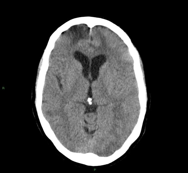 File:Cerebral amyloid angiopathy-associated lobar intracerebral hemorrhage (Radiopaedia 58529-65686 Axial non-contrast 12).jpg