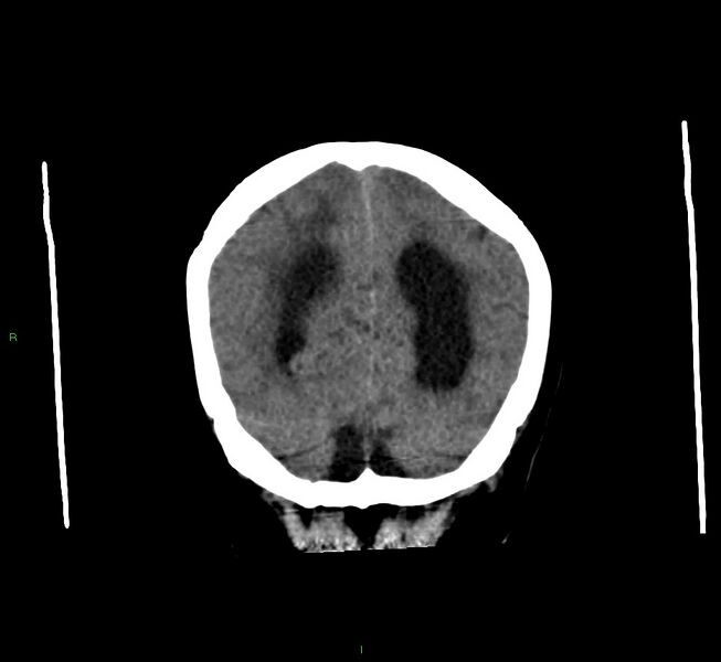 File:Cerebral amyloid angiopathy-associated lobar intracerebral hemorrhage (Radiopaedia 58560-65723 Coronal non-contrast 17).jpg