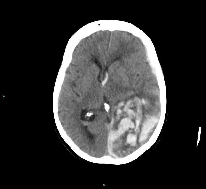 Cerebral amyloid angiopathy-associated lobar intracerebral hemorrhage (Radiopaedia 58754-65975 Axial non-contrast 34).jpg