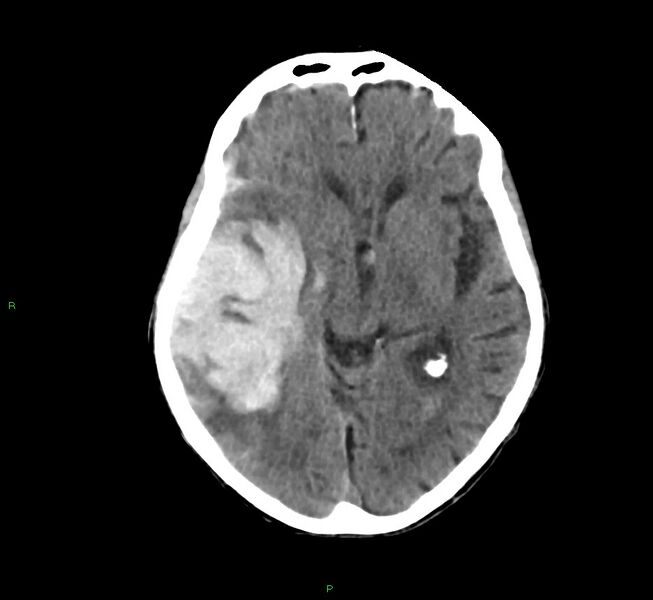 File:Cerebral amyloid angiopathy-associated lobar intracerebral hemorrhage (Radiopaedia 58758-65980 Axial non-contrast 28).jpg