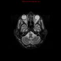Cerebral and orbital tuberculomas (Radiopaedia 13308-13311 Axial T2 5).jpg