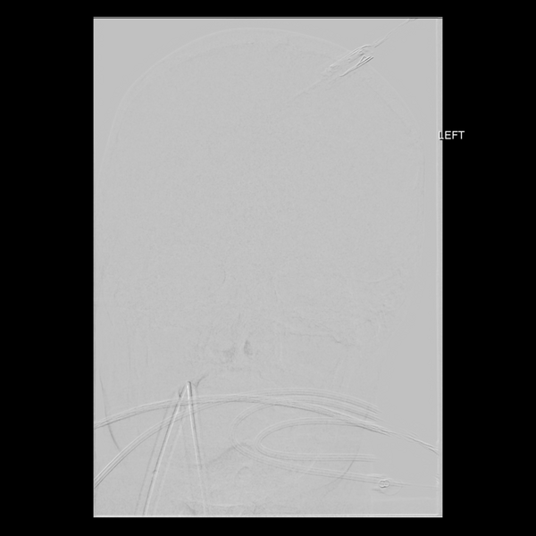 File:Cerebral arteriovenous malformation with lobar hemorrhage (Radiopaedia 44725-48513 LT CCA IC 5).png