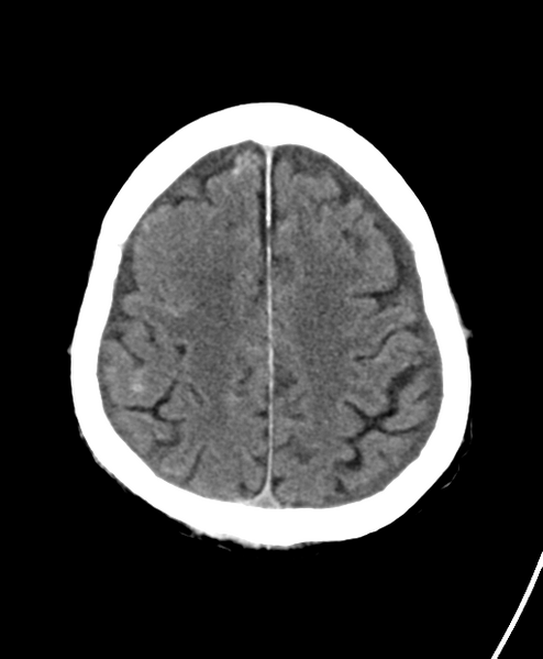 File:Cerebral contusions, subarachnoid hemorrhage and subdural hygromas (Radiopaedia 55399-61828 Axial non-contrast 21).png