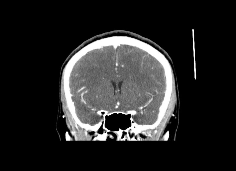 File:Cerebral edema (Radiopaedia 82519-96661 C 40).jpg